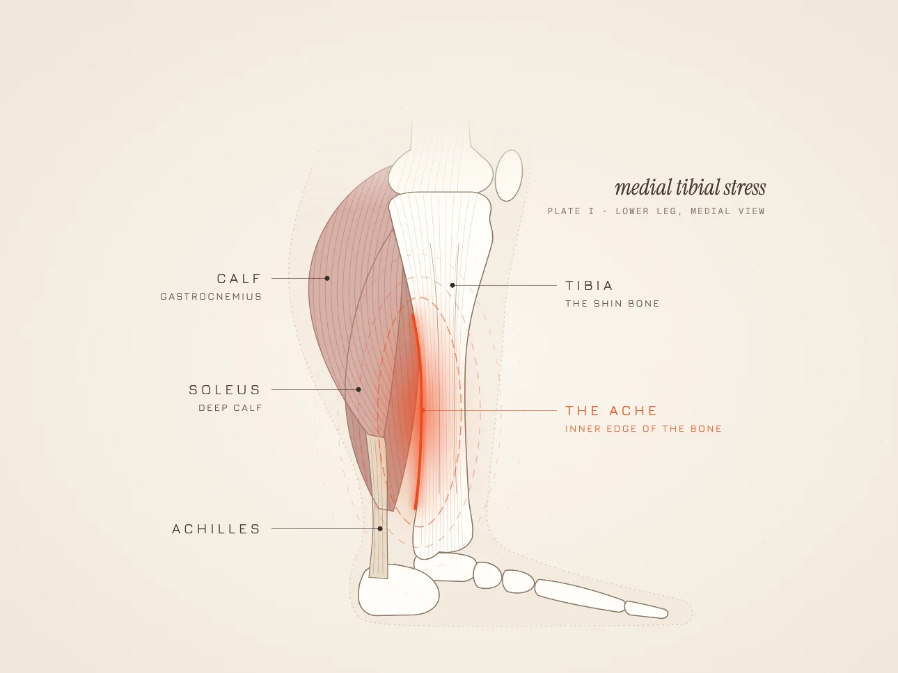 Shin Splints: Why They Happen and How to Get Back to Running